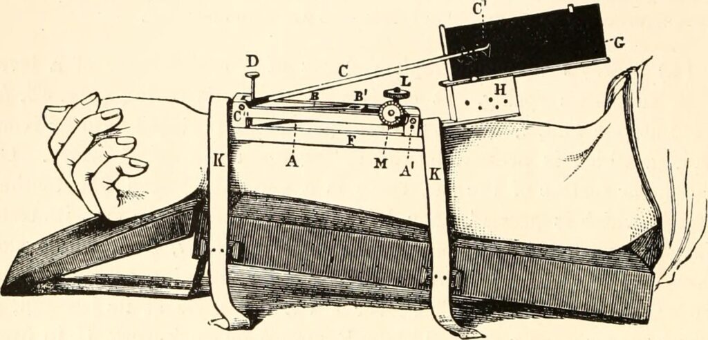 An illustration of a Sphygmograph, wrapped around a patients arm and recording the pulse on paper. 
